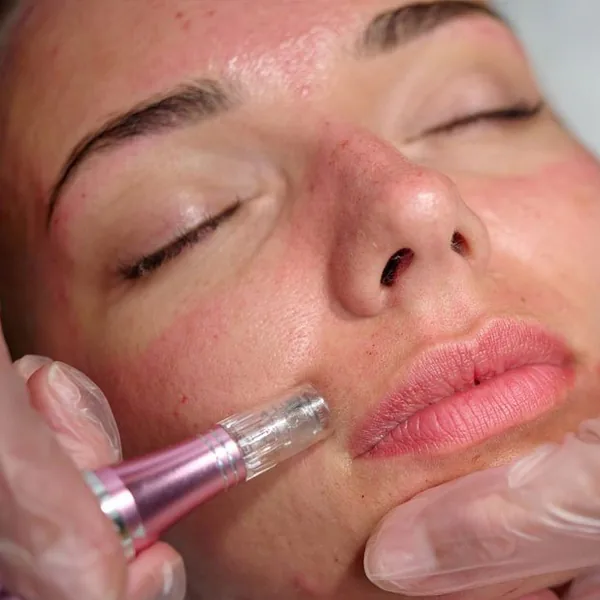 Microneedling with PRF treatment at MIHSA Aesthetics in New York City