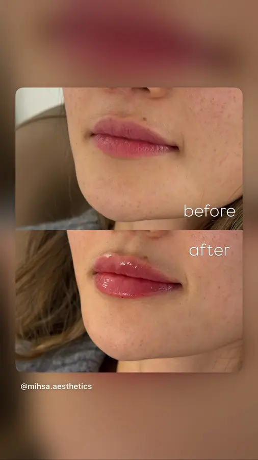 Before and After Result 11 before and after treatment result